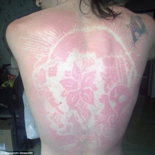 sunburn_art_1